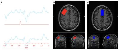 Exploring brain glutathione and peripheral blood markers in posttraumatic stress disorder: a combined [1H]MRS and peripheral blood study